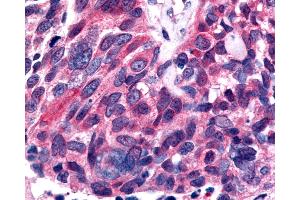 Anti-ESRRB / ERR Beta antibody IHC of human Lung, Small Cell Carcinoma. (ESRRB Antikörper  (Ligand Binding Domain))