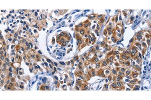 Immunohistochemistry of paraffin-embedded Human lung cancer tissue using MYH1 Polyclonal Antibody at dilution 1:40 (MYH1 Antikörper)