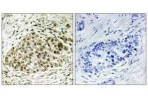 Immunohistochemistry analysis of paraffin-embedded human lung carcinoma tissue, using Lyl-1 antibody. (LYL1 Antikörper)