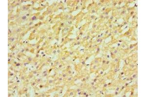 Immunohistochemistry of paraffin-embedded human liver cancer using ABIN7170658 at dilution of 1:100 (FDFT1 Antikörper  (AA 1-260))