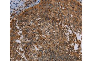 Immunohistochemistry of Human colon cancer using OSM Polyclonal Antibody at dilution of 1:30