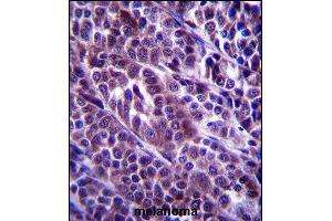 ARMC9 Antibody (N-term) (ABIN657366 and ABIN2846413) immunohistochemistry analysis in formalin fixed and paraffin embedded human melanoma followed by peroxidase conjugation of the secondary antibody and DAB staining. (ARMC9 Antikörper  (N-Term))