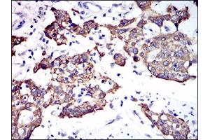 Immunohistochemical analysis of paraffin-embedded esophagus cancer tissues using CK5 mouse mAb with DAB staining. (Cytokeratin 5 Antikörper  (AA 316-590))