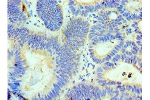 Immunohistochemistry of paraffin-embedded human colon cancer using ABIN7143718 at dilution of 1:100 (ALKBH8 Antikörper  (AA 1-230))