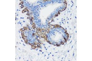 Immunohistochemistry of paraffin-embedded human breast cancer using Filamin A antibody (ABIN7267206) at dilution of 1:100 (40x lens). (Filamin A Antikörper  (C-Term))