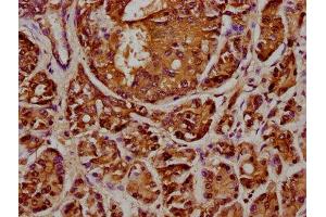 IHC image of ABIN7144072 diluted at 1:348 and staining in paraffin-embedded human pancreatic cancer performed on a Leica BondTM system. (ANAPC2 Antikörper  (AA 1-230))