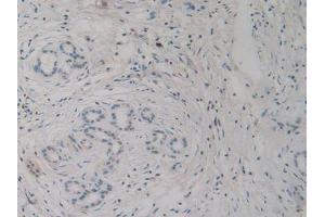 IHC-P analysis of Human Pancreas Cancer Tissue, with DAB staining. (H2AFY Antikörper  (AA 109-369))