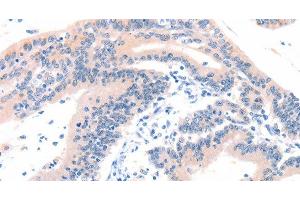 Immunohistochemistry of paraffin-embedded Human colon cancer tissue using ITGA6 Polyclonal Antibody at dilution 1:50 (ITGA6 Antikörper)