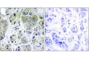 Immunohistochemistry analysis of paraffin-embedded human breast carcinoma tissue, using p70 S6 Kinase (Ab-411) Antibody. (RPS6KB1 Antikörper  (AA 401-450))