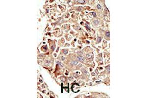 Formalin-fixed and paraffin-embedded human hepatocellular carcinoma tissue reacted with ACVR1 polyclonal antibody  , which was peroxidase-conjugated to the secondary antibody, followed by DAB staining. (ACVR1 Antikörper  (Internal Region))