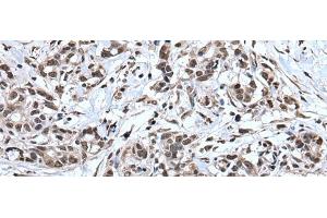 Immunohistochemistry of paraffin-embedded Human gastric cancer tissue using TIA1 Polyclonal Antibody at dilution of 1:30(x200) (TIA1 Antikörper)