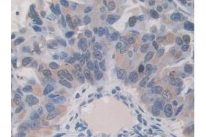 Detection of ITIH1 in Human Breast cancer Tissue using Polyclonal Antibody to Inter Alpha-Globulin Inhibitor H1 (ITIH1) (ITIH1 Antikörper  (AA 507-819))