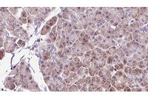 ABIN6273232 at 1/100 staining Human pancreas cancer tissue by IHC-P. (DBN1 Antikörper  (Internal Region))