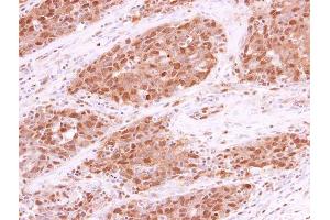 IHC-P Image RPA70 antibody [C1C3] detects RPA70 protein at cytoplasm and nucleus in human lung papillary adenocarcinoma by immunohistochemical analysis. (RPA1 Antikörper  (C-Term))