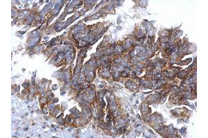 IHC-P Image CCR3 antibody [C2C3], C-term detects CCR3 protein at cytosol on human ovarian carcinoma by immunohistochemical analysis. (CCR3 Antikörper  (C-Term))