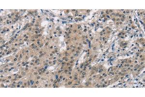 Immunohistochemistry of paraffin-embedded Human gastric cancer using SMAD9 Polyclonal Antibody at dilution of 1:30 (SMAD9 Antikörper)