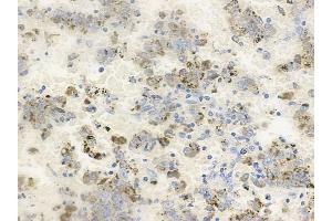 ABIN6256537 and ABIN6267228 at 1/100 staining human melanoma by IHC-P.