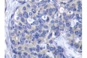 Immunohistochemistry analyzes of ZAP-70 antibody in paraffin-embedded human breast carcinoma tissue. (ZAP70 Antikörper)