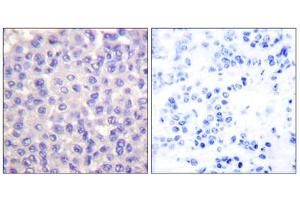 Immunohistochemical analysis of paraffin-embedded human breast carcinoma tissue using TGF beta 3 antibody (ABIN5976517). (TGFB3 Antikörper  (Internal Region))