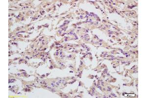 Formalin-fixed and paraffin embedded human gastric carcinoma labeled with Anti-MCM5 Polyclonal Antibody, Unconjugated (ABIN749648) at 1:200 followed by conjugation to the secondary antibody and DAB staining (MCM5 Antikörper  (AA 651-734))