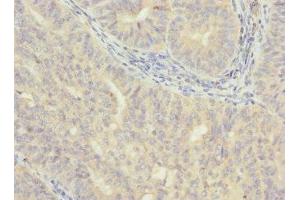 Immunohistochemistry of paraffin-embedded human endometrial cancer using ABIN7175638 at dilution of 1:100 (VHLL Antikörper  (AA 1-139))