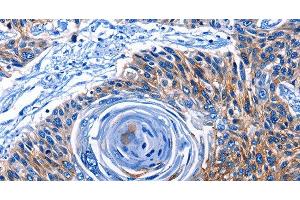 Immunohistochemistry of paraffin-embedded Human esophagus cancer tissue using CLEC2B Polyclonal Antibody at dilution 1:50 (CLEC2B Antikörper)