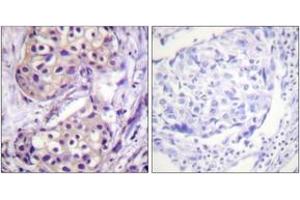 Immunohistochemistry analysis of paraffin-embedded human breast carcinoma tissue, using IKK-beta (Ab-199) Antibody. (IKBKB Antikörper  (AA 166-215))