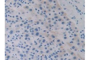 Detection of APOA5 in Human Liver cancer Tissue using Polyclonal Antibody to Apolipoprotein A5 (APOA5)