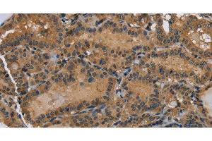 Immunohistochemistry of paraffin-embedded Human thyroid cancer using HSP40-4 Polyclonal Antibody at dilution of 1:60 (HSP40-4 Antikörper)