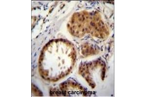 E2EPF Antibody (C-term) (ABIN388858 and ABIN2839160) immunohistochemistry analysis in formalin fixed and paraffin embedded human breast carcinoma followed by peroxidase conjugation of the secondary antibody and DAB staining. (UBE2S Antikörper  (C-Term))