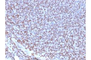 Formalin-fixed, paraffin-embedded human Ewing's Sarcoma stained with NKX2.