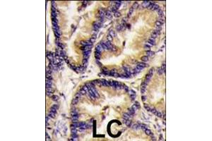 Formalin-fixed and paraffin-embedded human lung carcinoma tissue reacted with VEGF2 antibody , which was peroxidase-conjugated to the secondary antibody, followed by DAB staining.