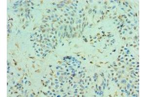 Immunohistochemistry of paraffin-embedded human breast cancer using ABIN7147590 at dilution of 1:100
