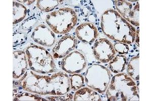 Immunohistochemical staining of paraffin-embedded Carcinoma of liver tissue using anti-LIPG mouse monoclonal antibody. (LIPG Antikörper)