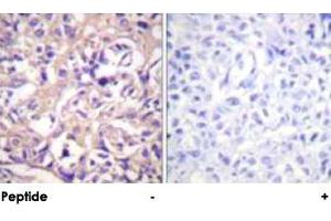 Immunohistochemical analysis of paraffin-embedded human breast carcinoma tissue using TK1 polyclonal antibody . (TK1 Antikörper  (Ser13))