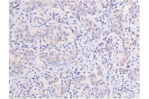 Immunohistochemistry (IHC) image for anti-PTK2 Protein tyrosine Kinase 2 (PTK2) (pTyr576) antibody (ABIN6256766)