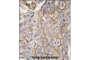 Formalin-fixed and paraffin-embedded human lung carcinoma tissue reacted with CLIC1 antibody, which was peroxidase-conjugated to the secondary antibody, followed by DAB staining. (CLIC1 Antikörper)