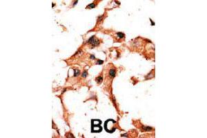 Formalin-fixed and paraffin-embedded human cancer tissue reacted with BIRC3 polyclonal antibody  , which was peroxidase-conjugated to the secondary antibody, followed by DAB staining. (BIRC3 Antikörper  (N-Term))