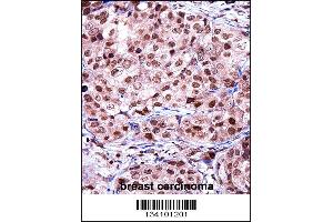 TERF2IP Antibody immunohistochemistry analysis in formalin fixed and paraffin embedded human breast carcinoma followed by peroxidase conjugation of the secondary antibody and DAB staining. (RAP1 Antikörper  (C-Term))