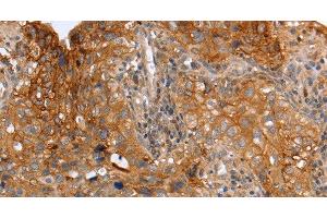 Immunohistochemistry of paraffin-embedded Human cervical cancer using PLAUR Polyclonal Antibody at dilution of 1:60 (PLAUR Antikörper)