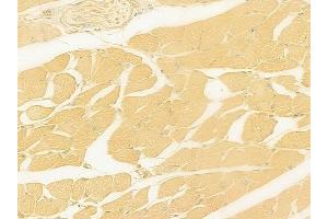 ABIN6262561 and ABIN6278898 at 1/100 staining human tongue carcinoma by IHC-P. (IL28B Antikörper  (Internal Region))