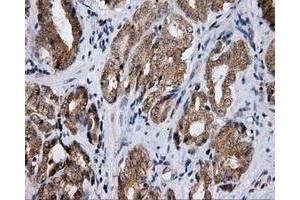 Immunohistochemical staining of paraffin-embedded Adenocarcinoma of ovary tissue using anti-LIPG mouse monoclonal antibody. (LIPG Antikörper)