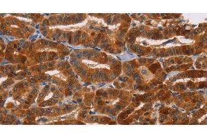 Immunohistochemistry of paraffin-embedded Human thyroid cancer tissue using NCR1 Polyclonal Antibody at dilution 1:30 (NCR1 Antikörper)