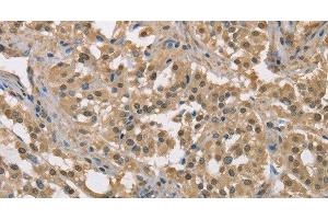 Immunohistochemistry of paraffin-embedded Human thyroid cancer tissue using DACH2 Polyclonal Antibody at dilution 1:40