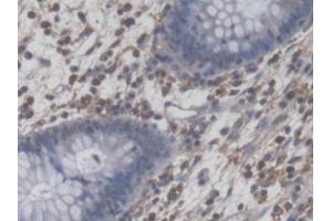 DAB staining on IHC-P; Samples: Human Colorectal cancer Tissue (NFIA Antikörper  (AA 1-143))