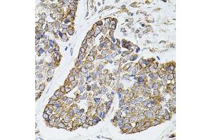 Immunohistochemistry of paraffin-embedded human esophageal cancer using MTTP antibody (ABIN5970876) at dilution of 1/100 (40x lens). (MTTP Antikörper)