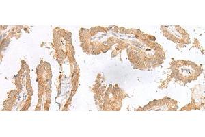 Immunohistochemistry of paraffin-embedded Human thyroid cancer tissue using CXCL6 Polyclonal Antibody at dilution of 1:45(x200) (CXCL6 Antikörper)