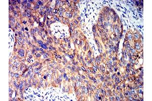 Immunohistochemical analysis of paraffin-embedded cervical cancer tissues using PRKAB2 mouse mAb with DAB staining. (PRKAB2 Antikörper  (AA 1-120))