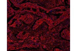 IF analysis of MYD88 using anti-MYD88 antibody (ABIN3043887) MYD88 was detected in paraffin-embedded section of human colon cancar tissues.