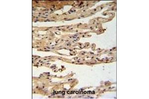 FKBPL Antibody (C-term) (ABIN1881347 and ABIN2840192) IHC analysis in formalin fixed and paraffin embedded lung carcinoma followed by peroxidase conjugation of the secondary antibody and DAB staining. (FKBPL Antikörper  (C-Term))